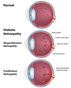 Diabetic Retinopathy-new
