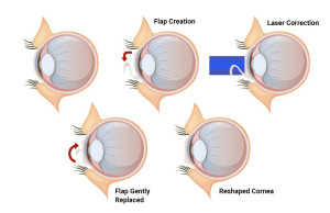 Lasik