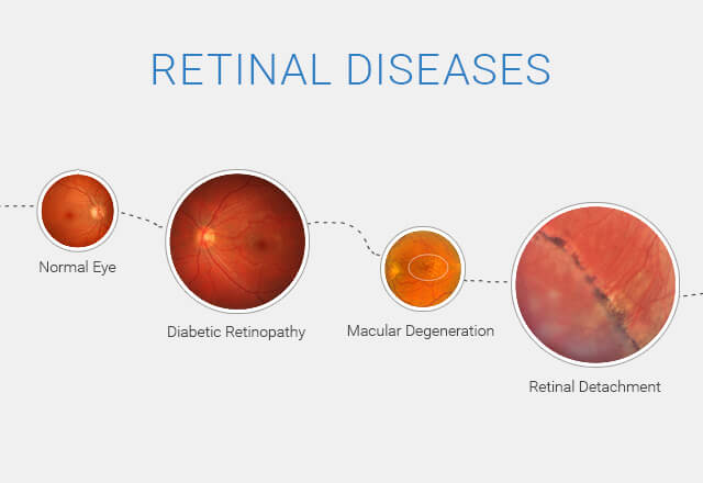 Retinal Tear vs. Retinal Detachment - Monterey, CA - Salinas