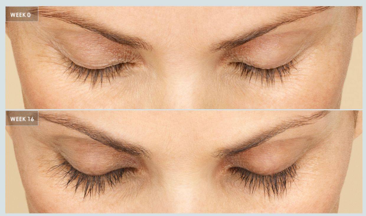 Latisse Eyelashes