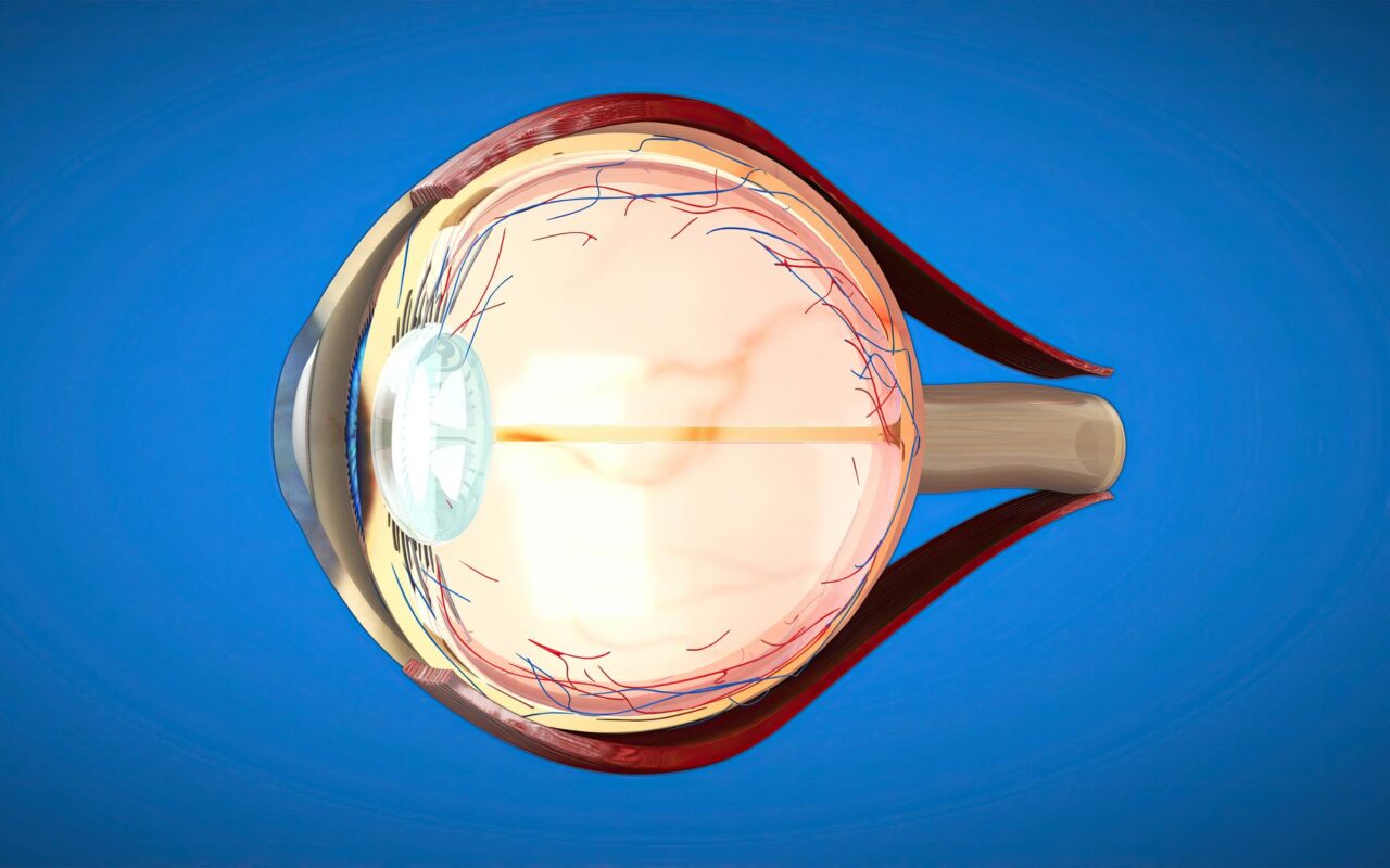 refractive errors of eye​