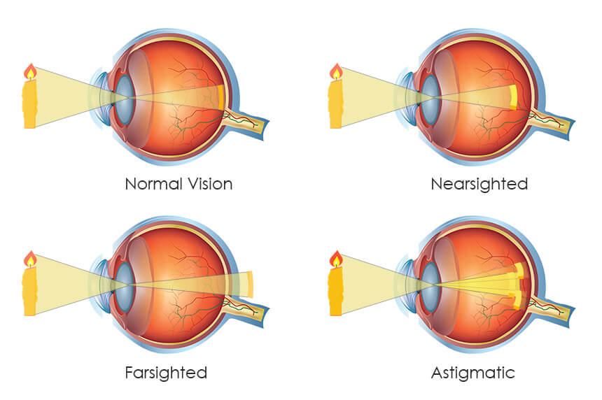 Is Nearsightedness Due to the Eyeball Being Too Long?
