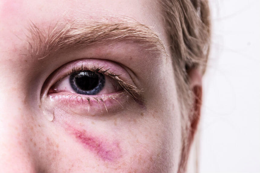 eye injury