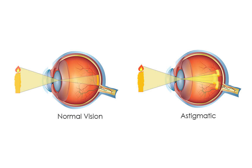 Facts You Did Not Know About Astigmatism InSight Vision Center