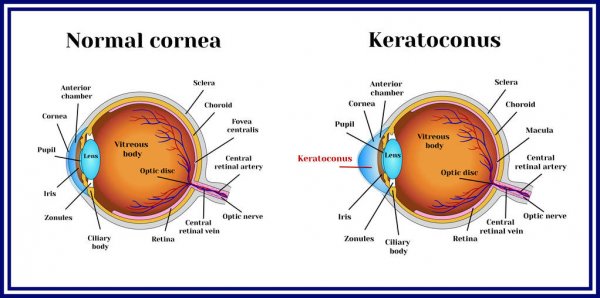 Corneal Cross-linking