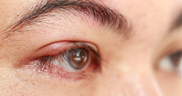 Chalazion, The Lump in Eyes