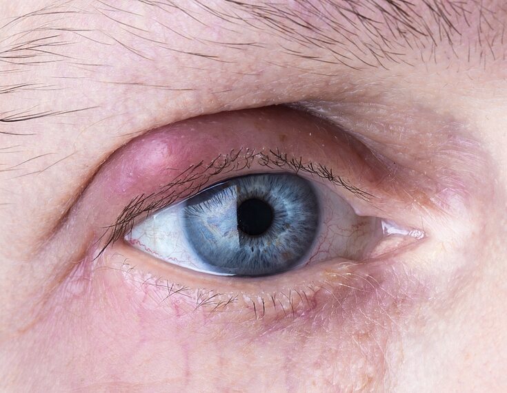 Symptoms, Treatments and More on Eye Herpes - InSight Vision Center