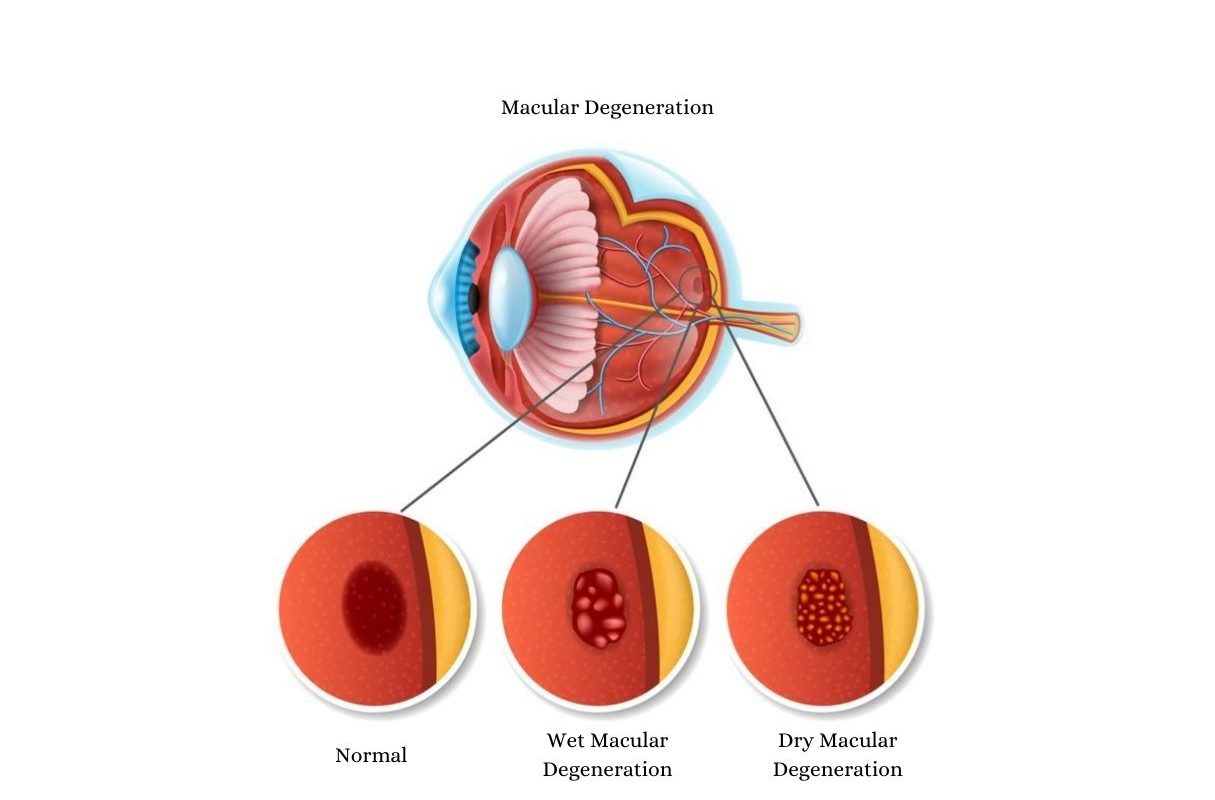 Macular Degeneration