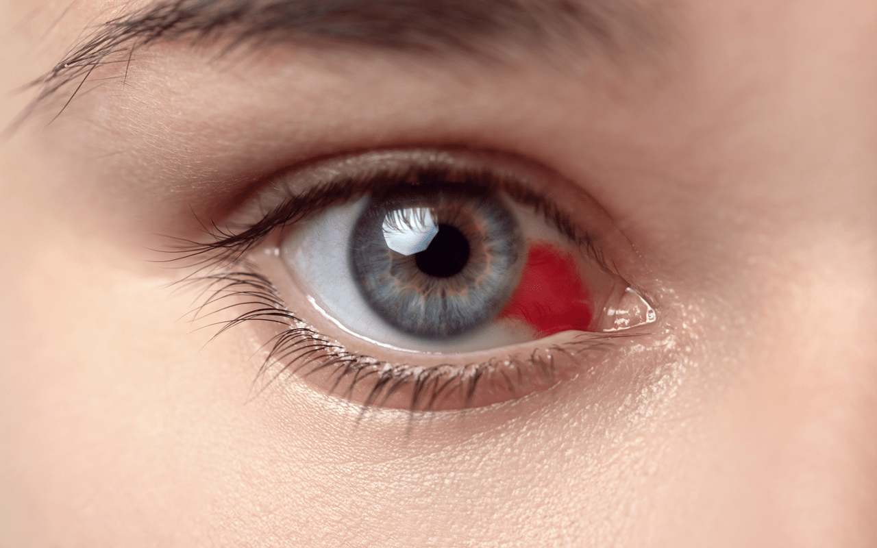 Ocular-hypertension