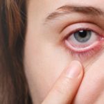 Retinal tear eye