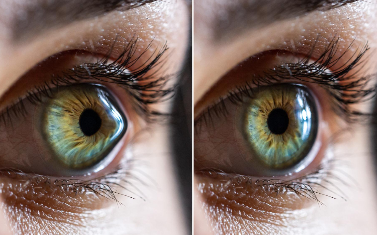 Irregular shape of your eye’s cornea or lens