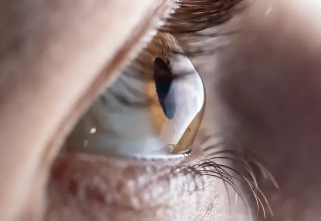 What is Keratoconus?
