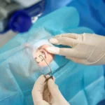 Catarct-Eye-Surgery-Twice